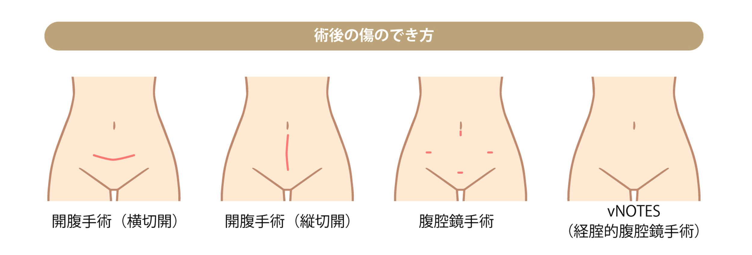 術後の傷のでき方イラスト