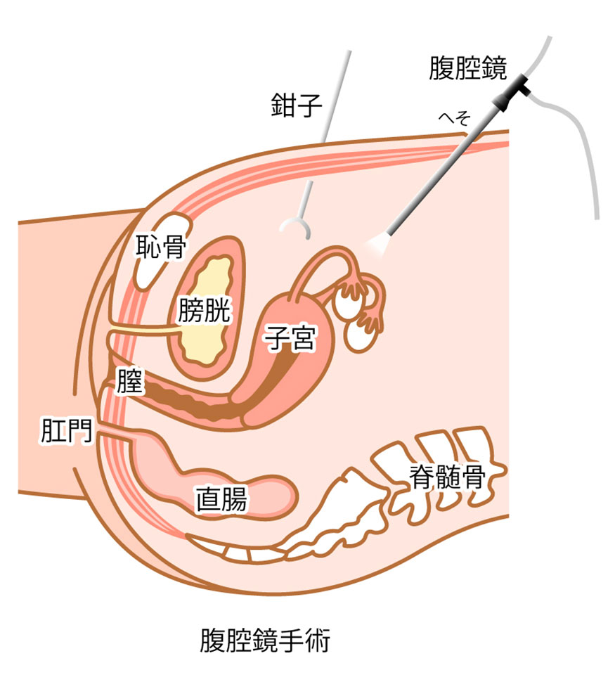 腹腔鏡手術イラスト