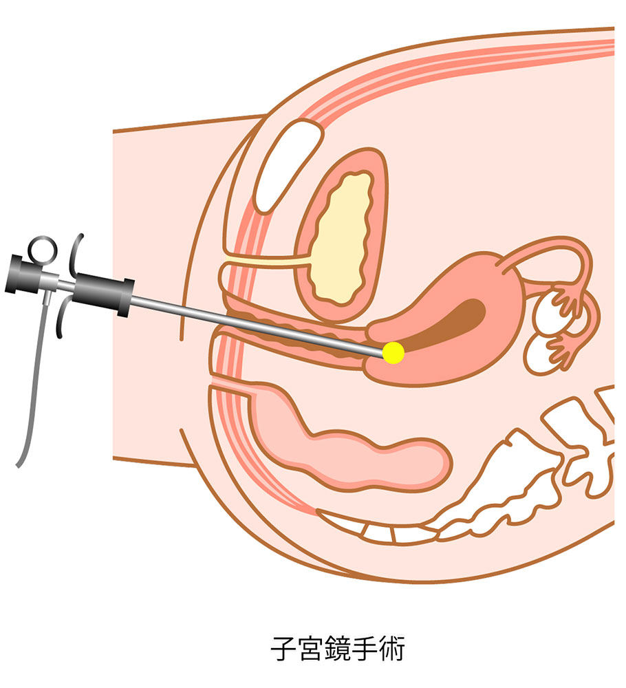 子宮鏡手術イラスト
